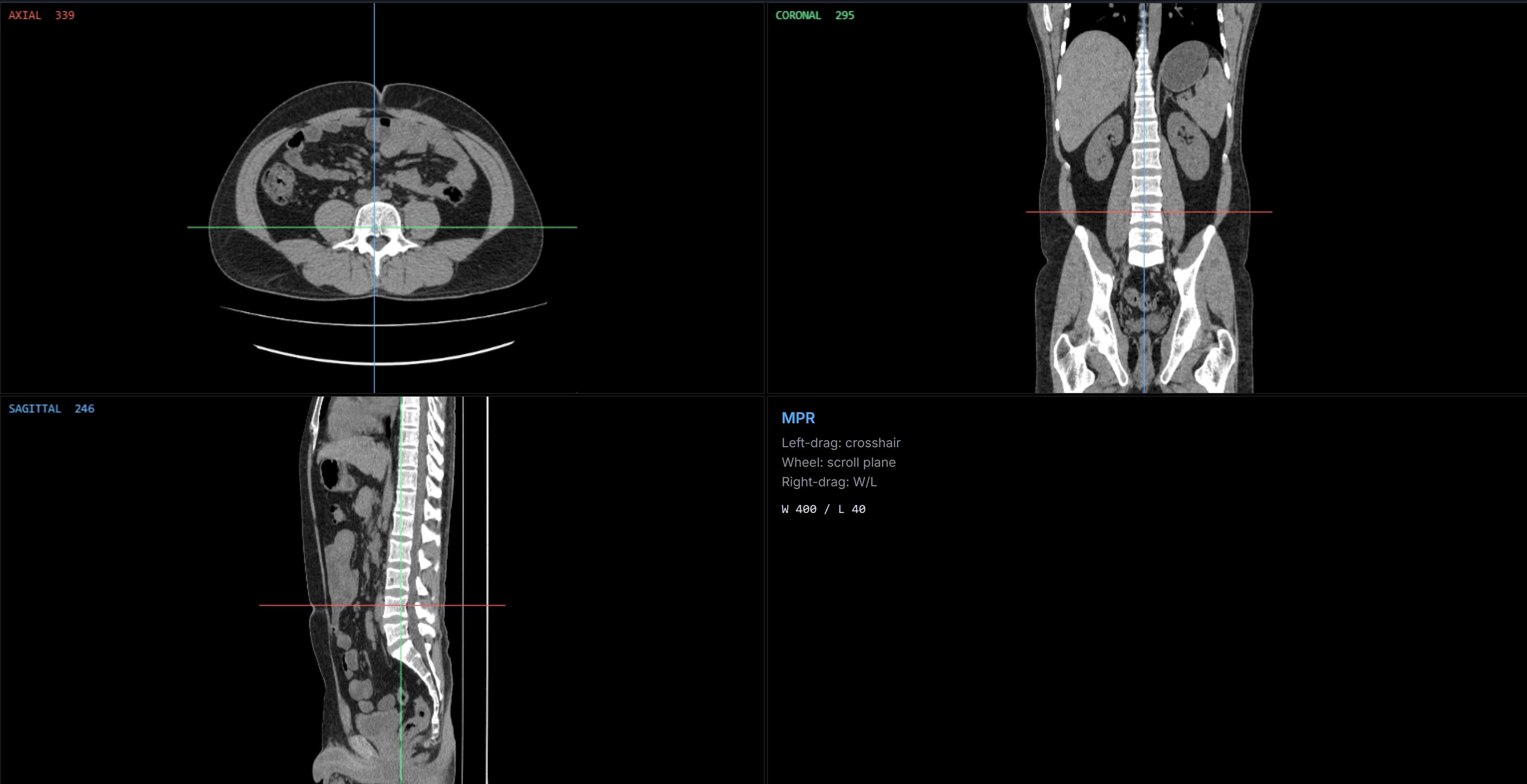 MPR 2×2 layout with a linked crosshair