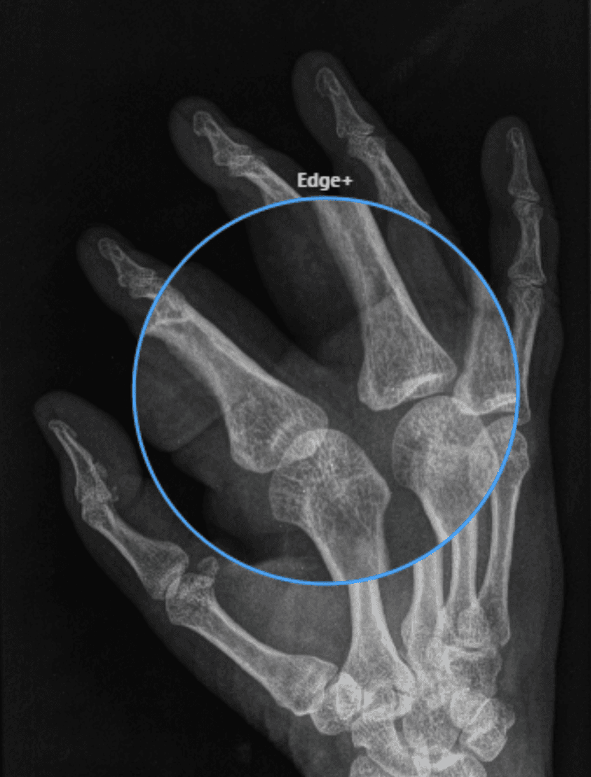 qLens over a region of a chest study