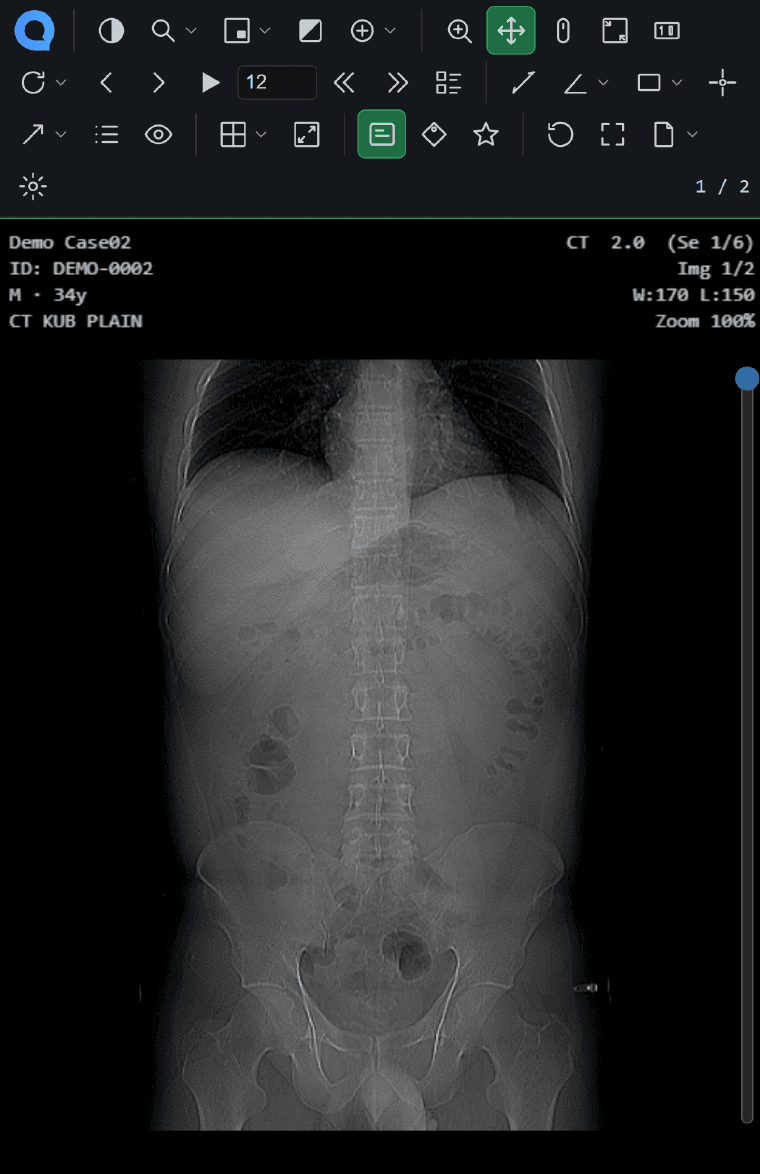 The qPACS viewer on a phone, showing a CT study with the full toolbar
